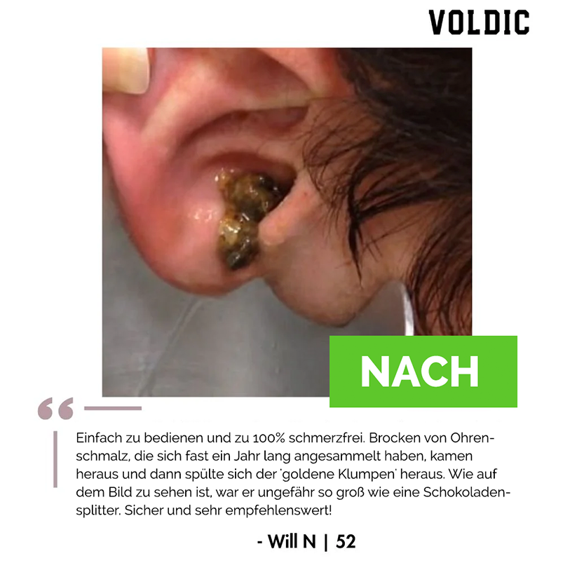 Voldic™ Elektrisches Ohrwachs-Entfernungsset