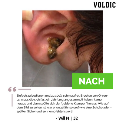 Voldic™ Elektrisches Ohrwachs-Entfernungsset