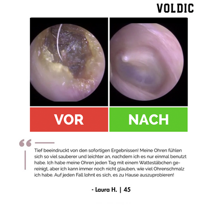 Voldic™ Elektrisches Ohrwachs-Entfernungsset